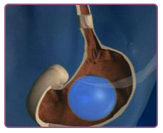 Balón intragástrico