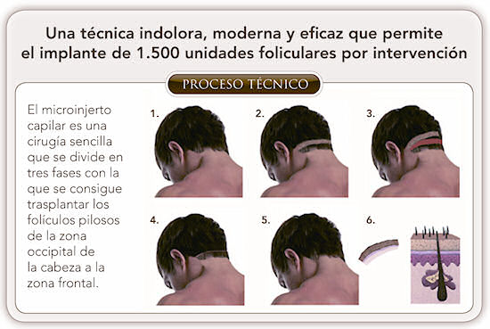 Tecnica FUSS de implante capilar.