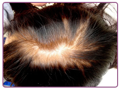 Será como si nunca hubiese perdido cabello