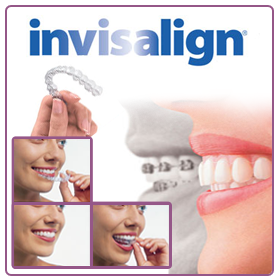 Invisalign - Ortodoncia invisible de quitar y poner