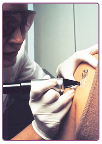 Eliminación de manchas en la piel y tatuajes