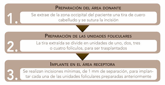 tecnica implante capilar.