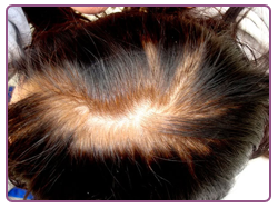 implante capilar: como si nunca hubiese perdido cabello