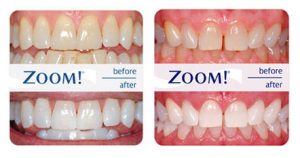 Zoom WhiteSpeed - Antes y Despues - Blanqueamiento Dental