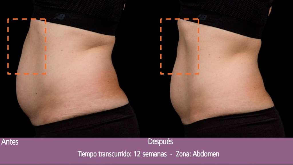 BA_SculpSure_L_Bass_Post1Tx_12weeks_05_OUS