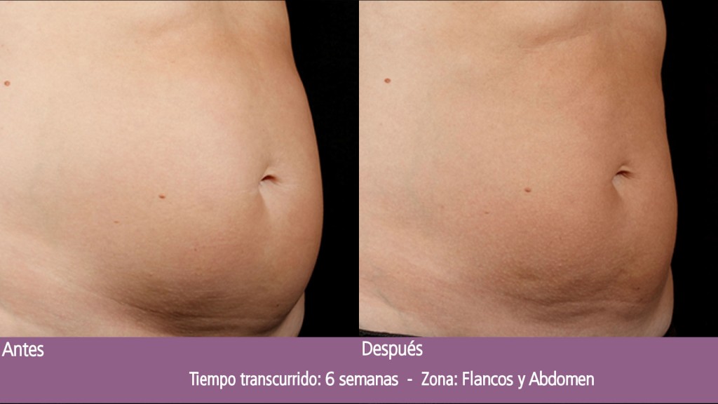 BA_SculpSure_S_Doherty_Post1Tx_6weeks_01_OUS