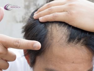 alopecia areata