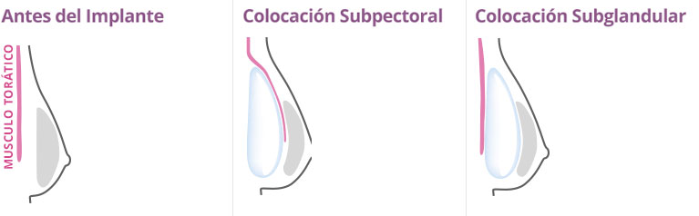 colocación implantes