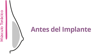 Colocación implantes mamarios