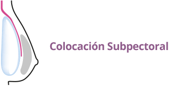 Colocación implantes mamarios subpectoral