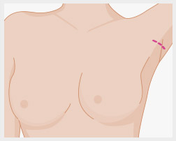 operación aumento de mamas