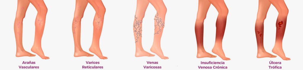 venas varicosas