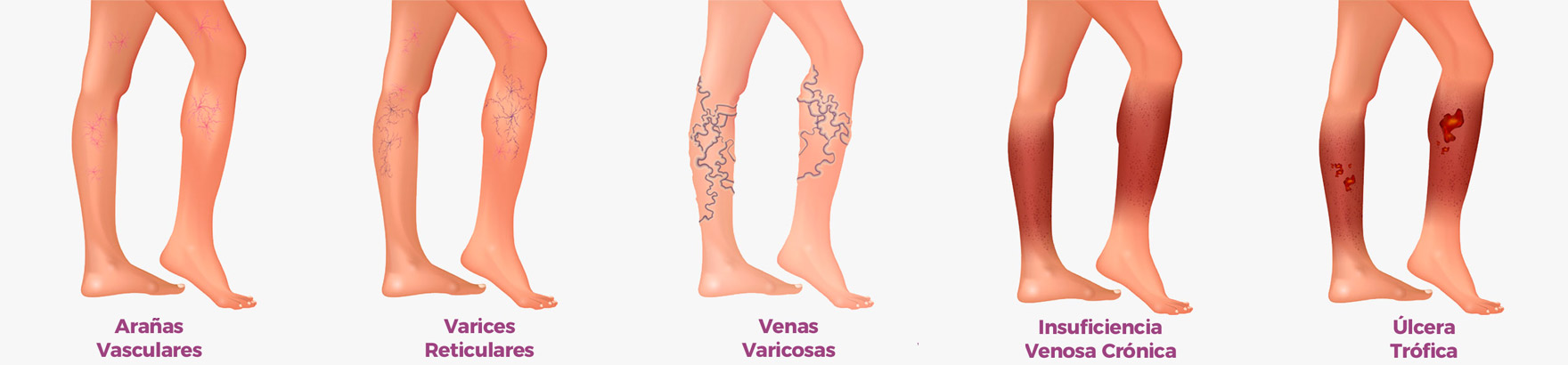 Eliminación de varices en función de su tipo