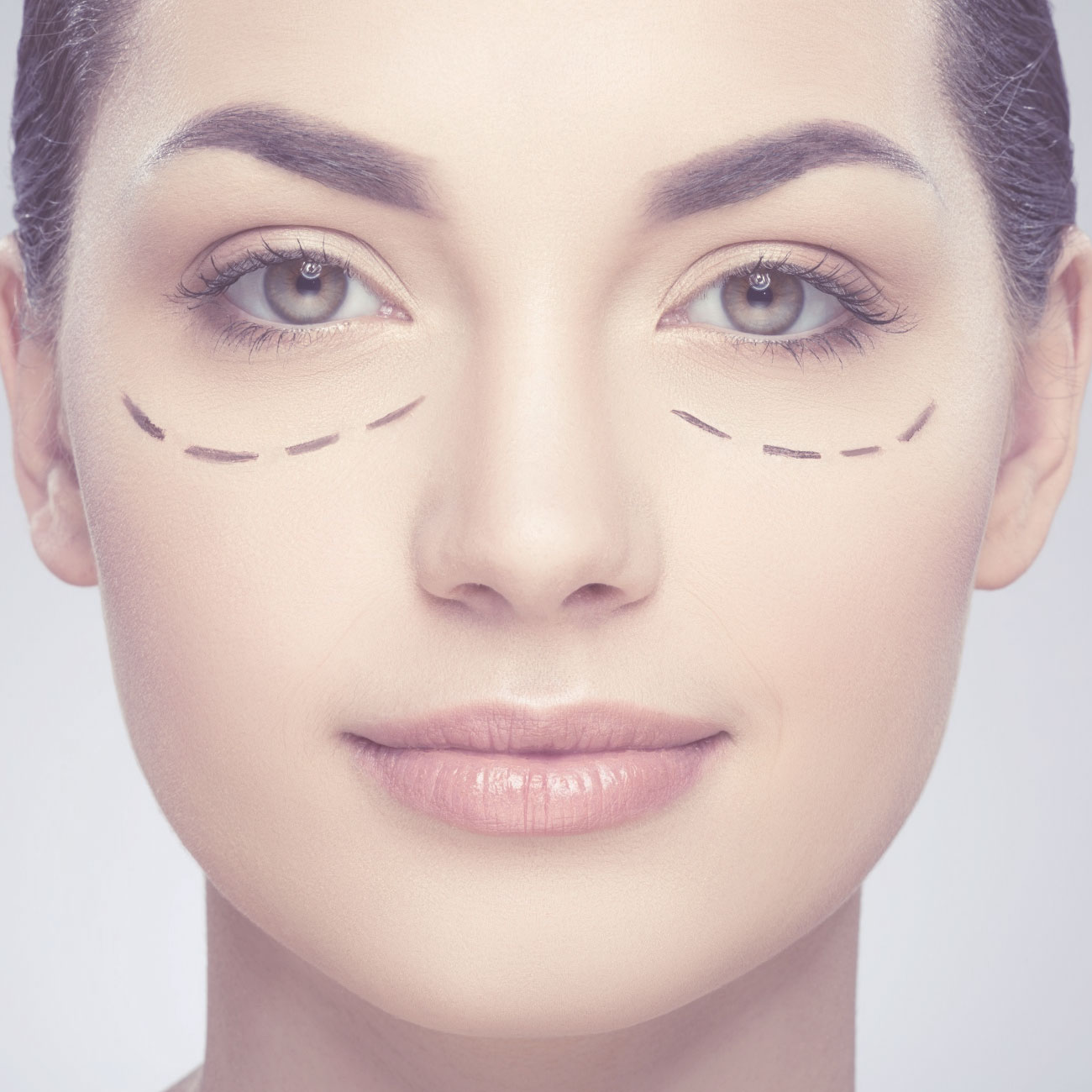 Blefaroplastia