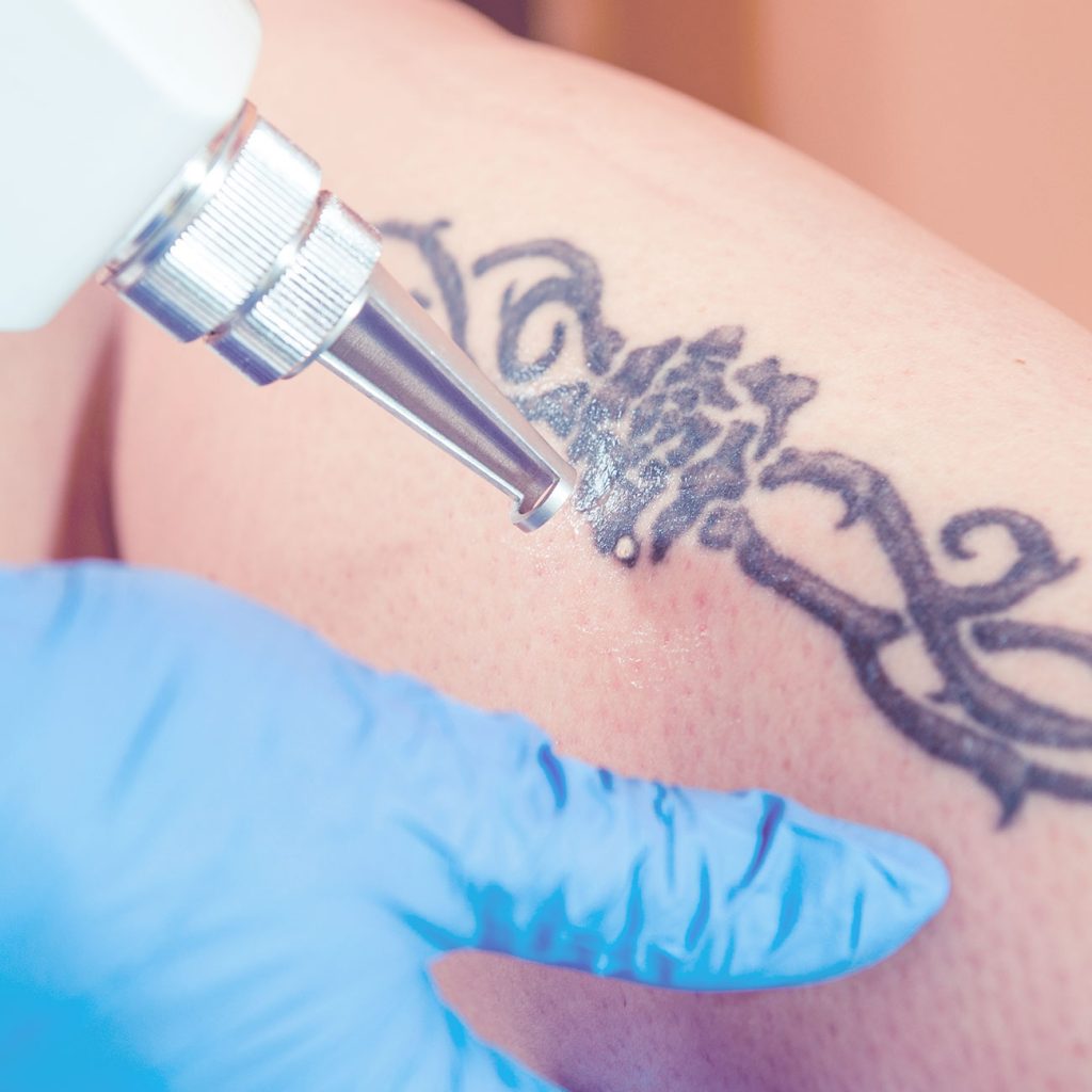 Tratamiento de eliminación de tatuajes