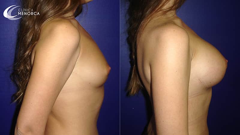 Antes y después de la cirugía de aumento de mamas