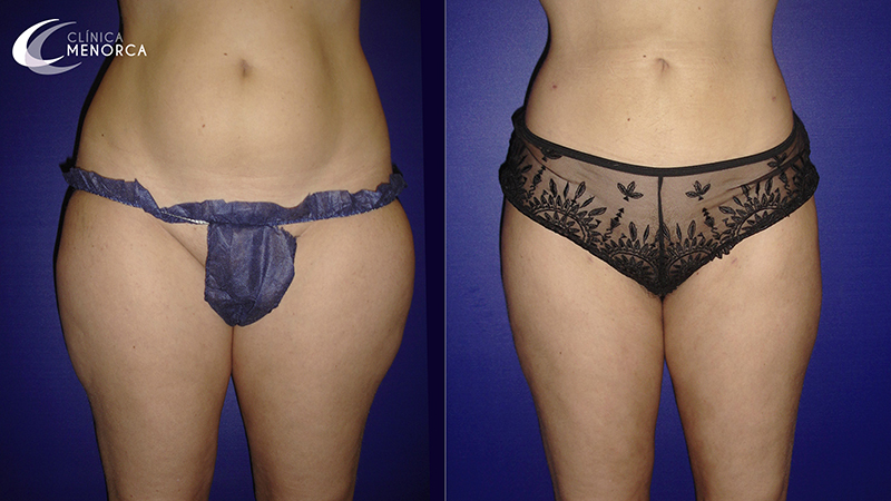 Fotos liposucción caderas antes y después
