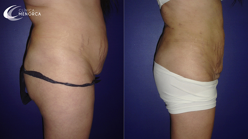 antes y despues de una lipo