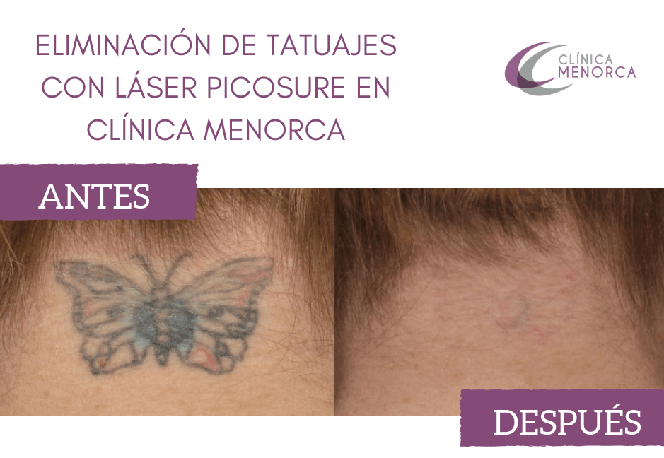 Antes y después: Eliminación de tatuajes con láser picosure en Clínica Menorca