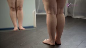 qué es lipedema