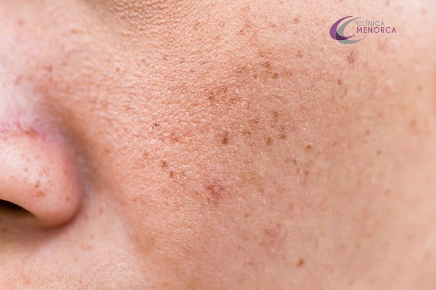 eliminar melasma