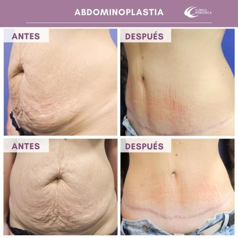 cm-abdominoplastia-01