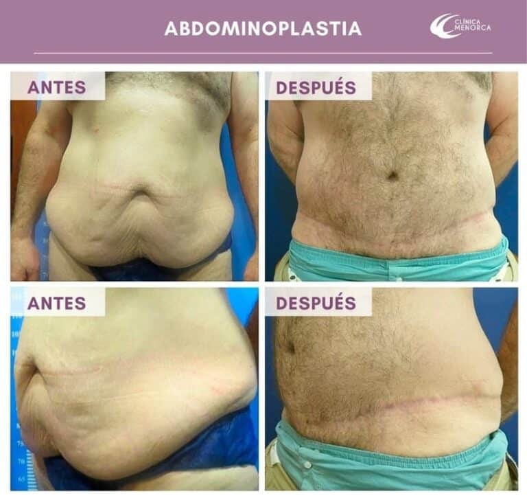 cm-abdominoplastia-02