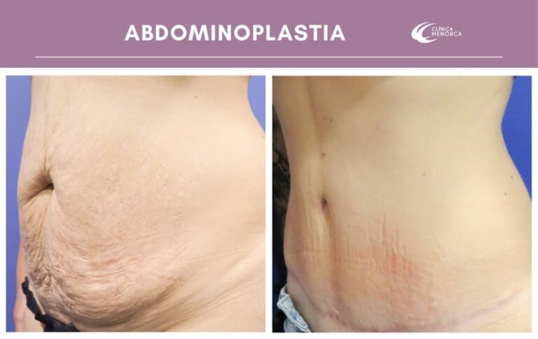 cm-abdominoplastia-03