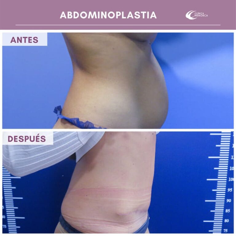 cm-abdominoplastia-04