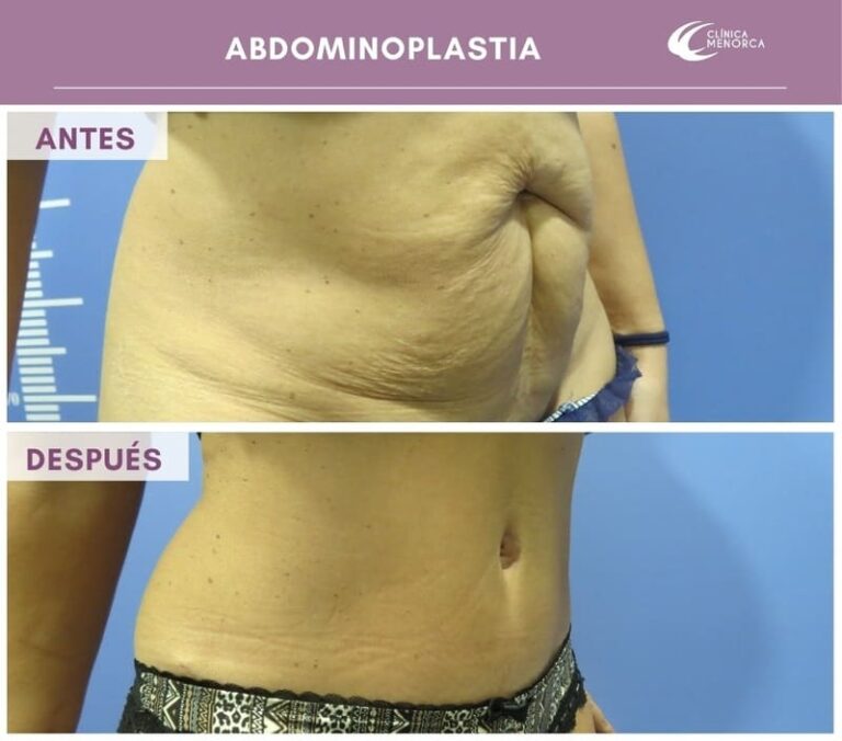 cm-abdominoplastia-05