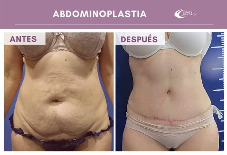 cm-abdominoplastia-06