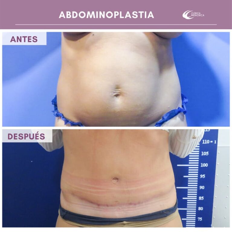 cm-abdominoplastia-07