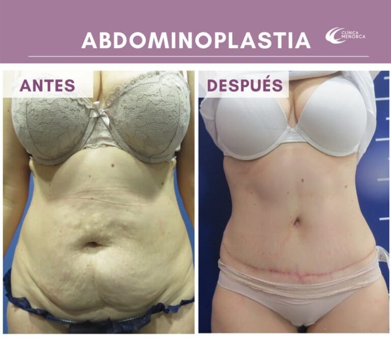 cm-abdominoplastia-09