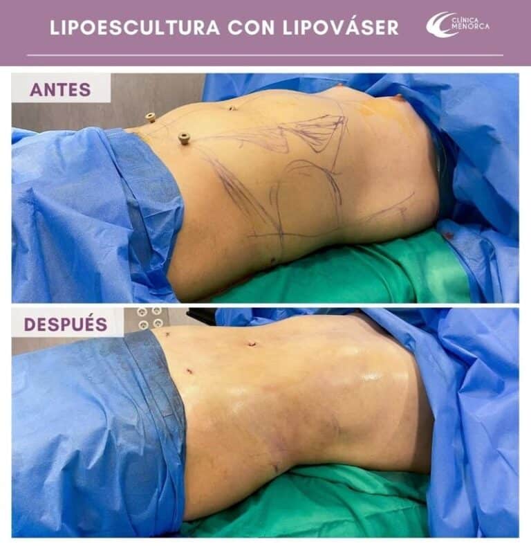 Lipo Vaser antes y despues 1