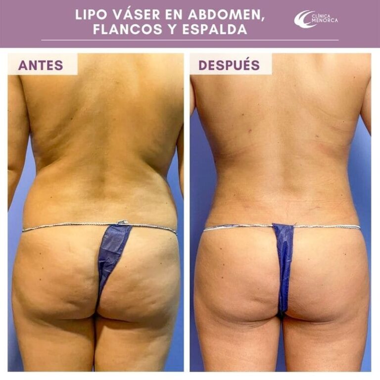 Lipo Vaser antes y despues 2