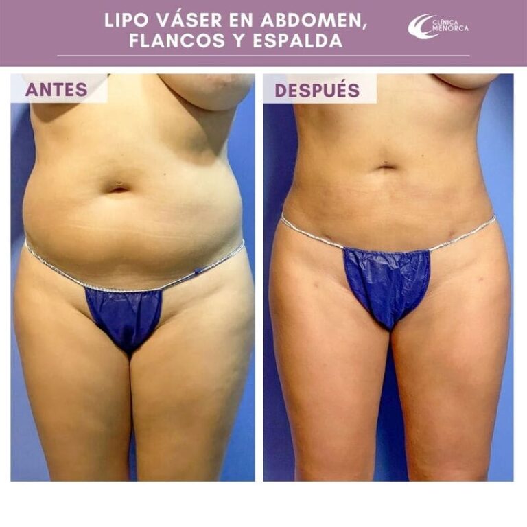 Lipo Vaser antes y despues 3