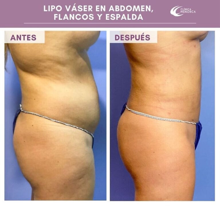 Lipo Vaser antes y despues 4