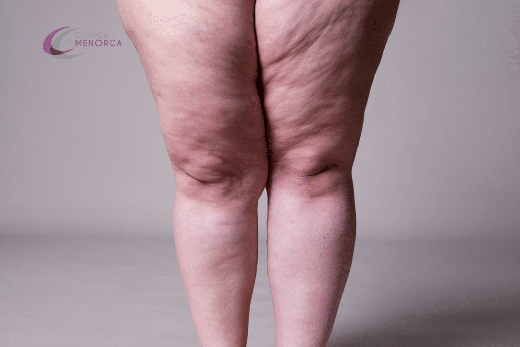 lipedema piernas