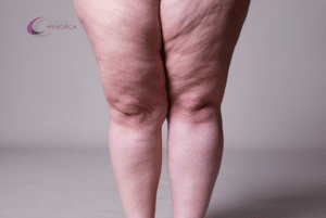 lipedema piernas